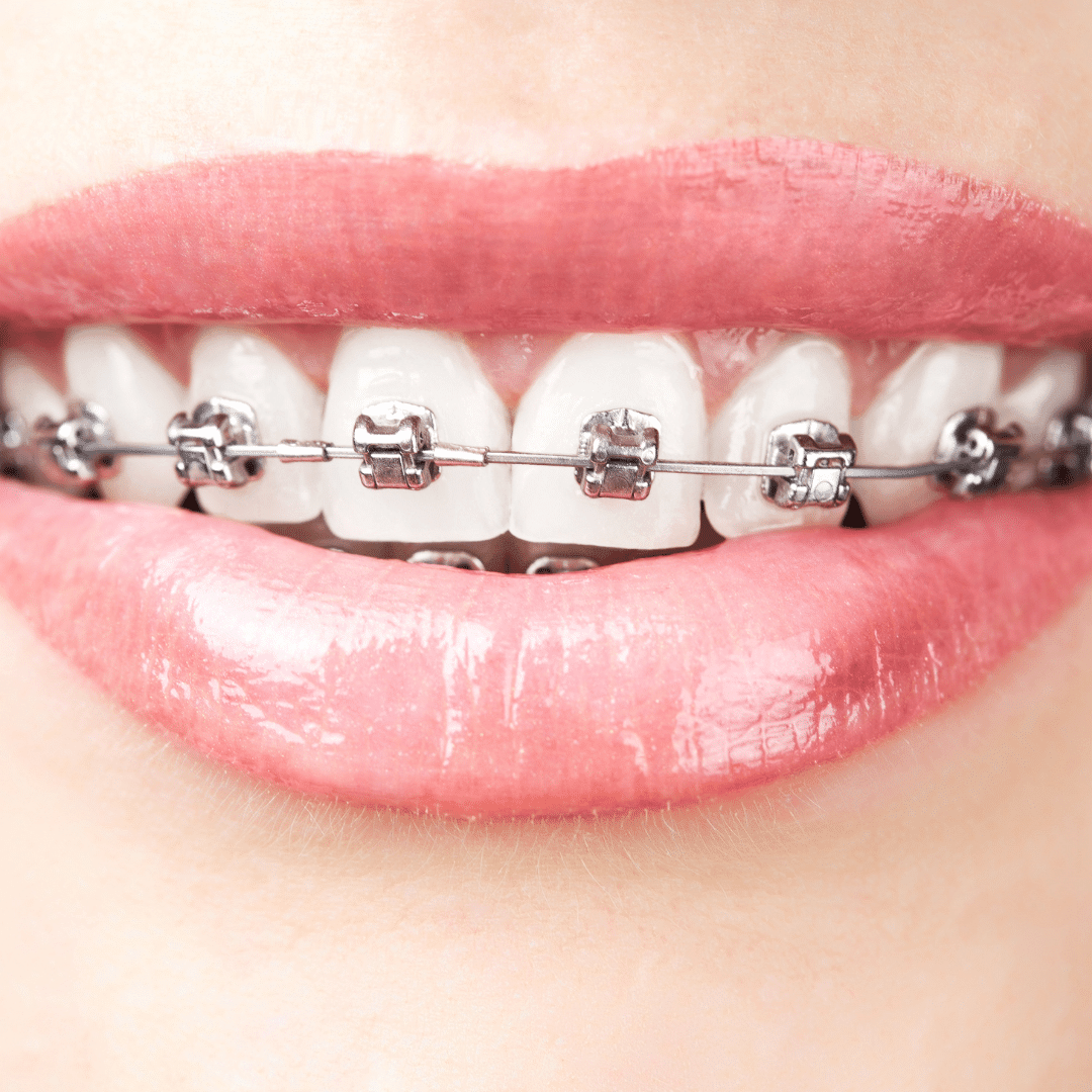 aparelho ortodontico autloligado