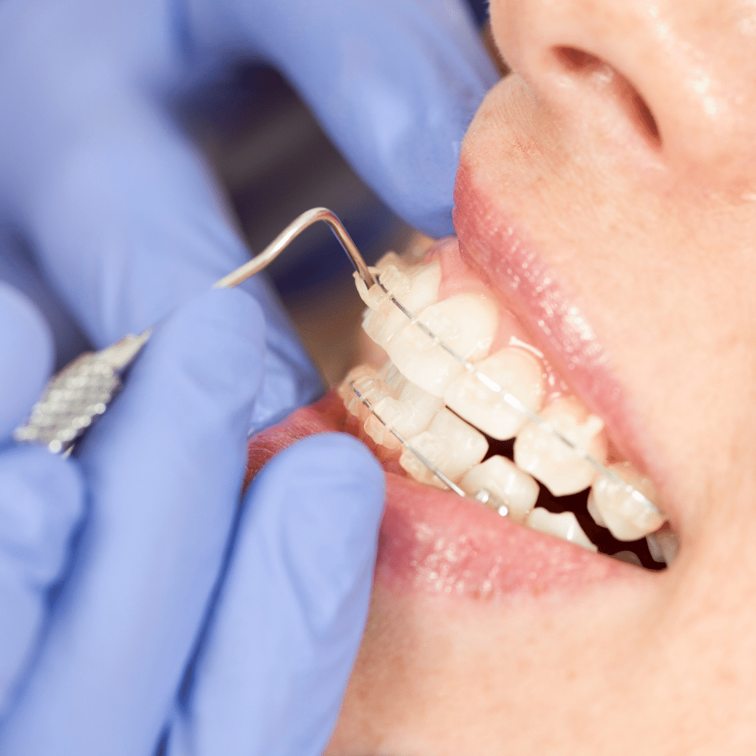 aparelho ortodontico transparente